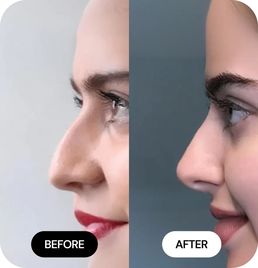 Liquid Nose Jobs before after 01