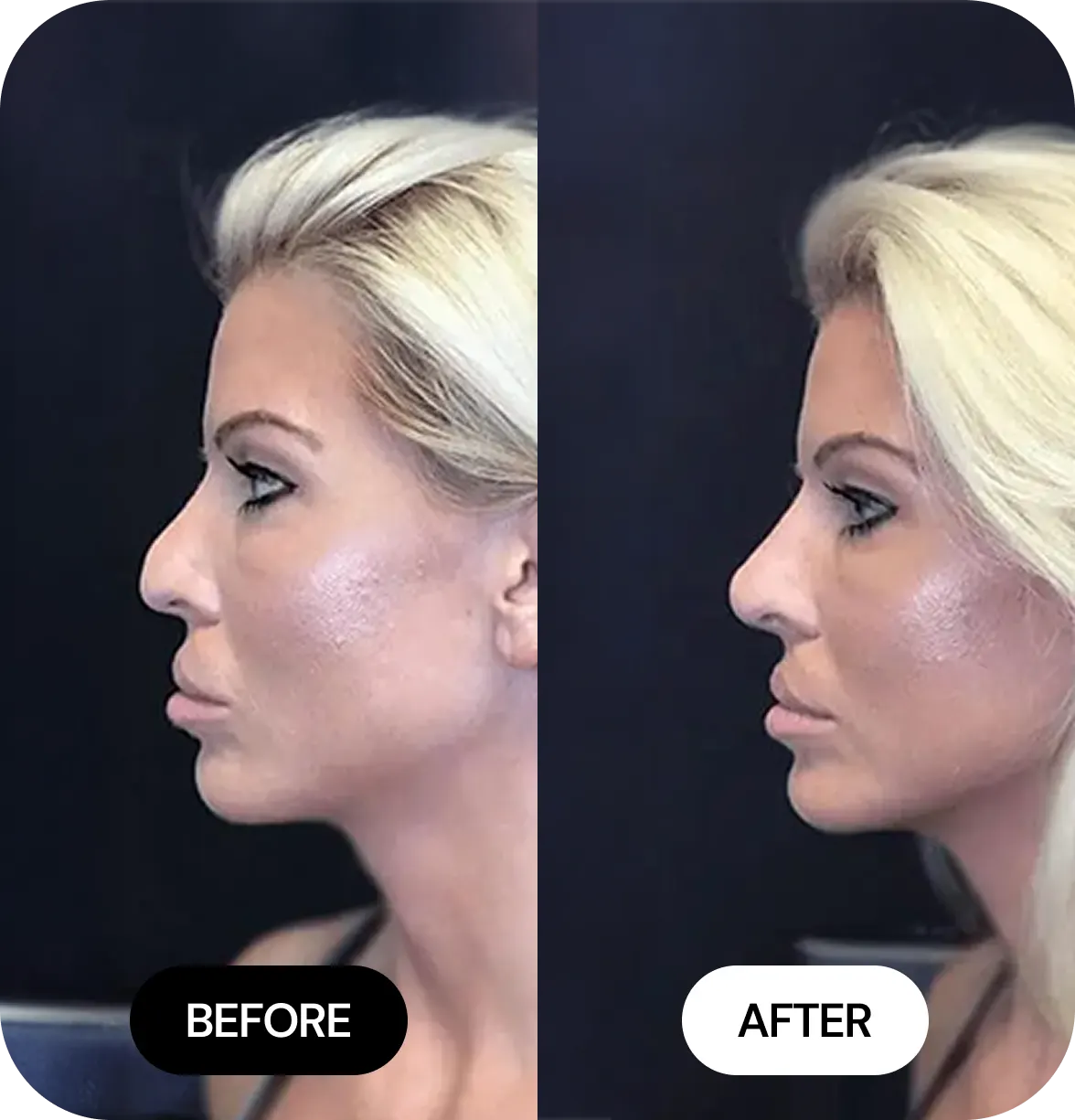Liquid Nose Jobs before after 02