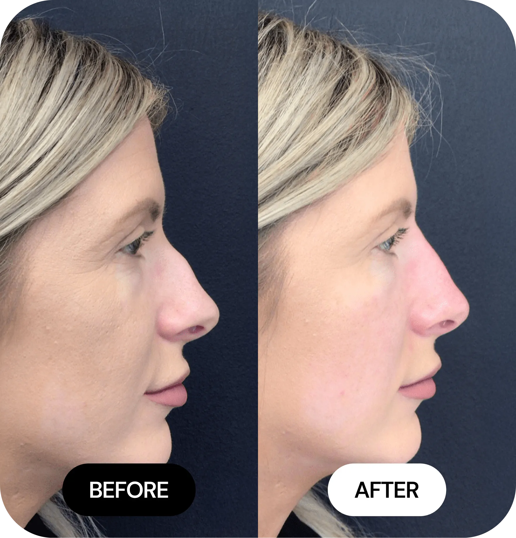 Liquid Nose Jobs before after 03