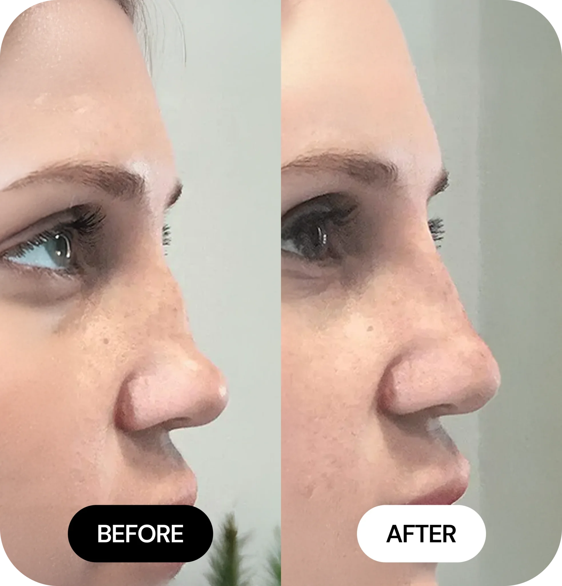 Liquid Nose Jobs before after 04
