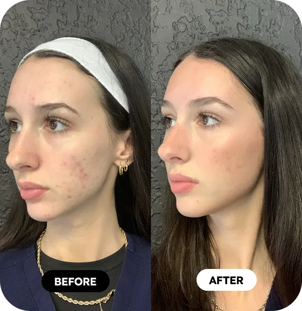 Microneedling before and after