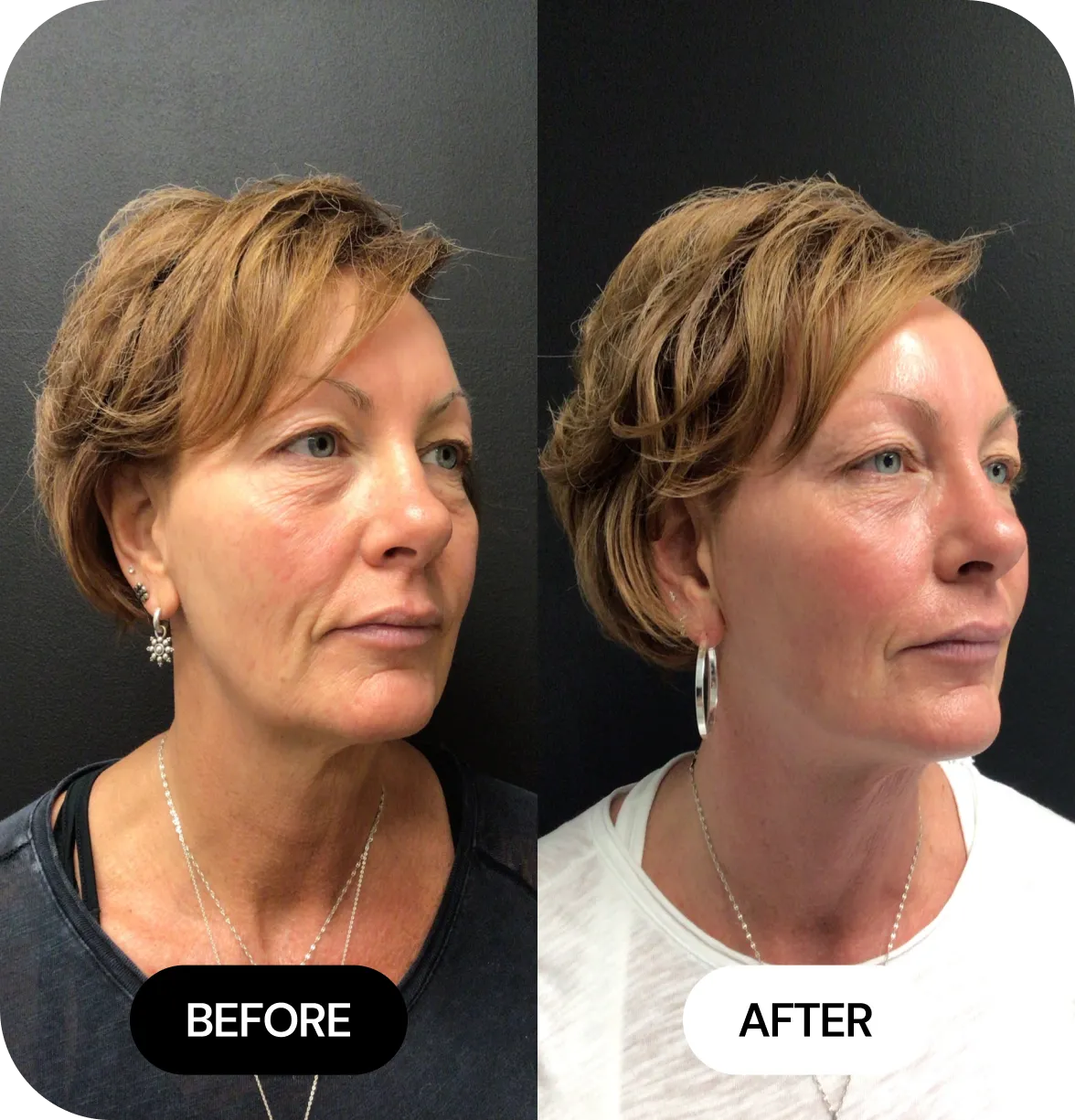 Microneedling before and after