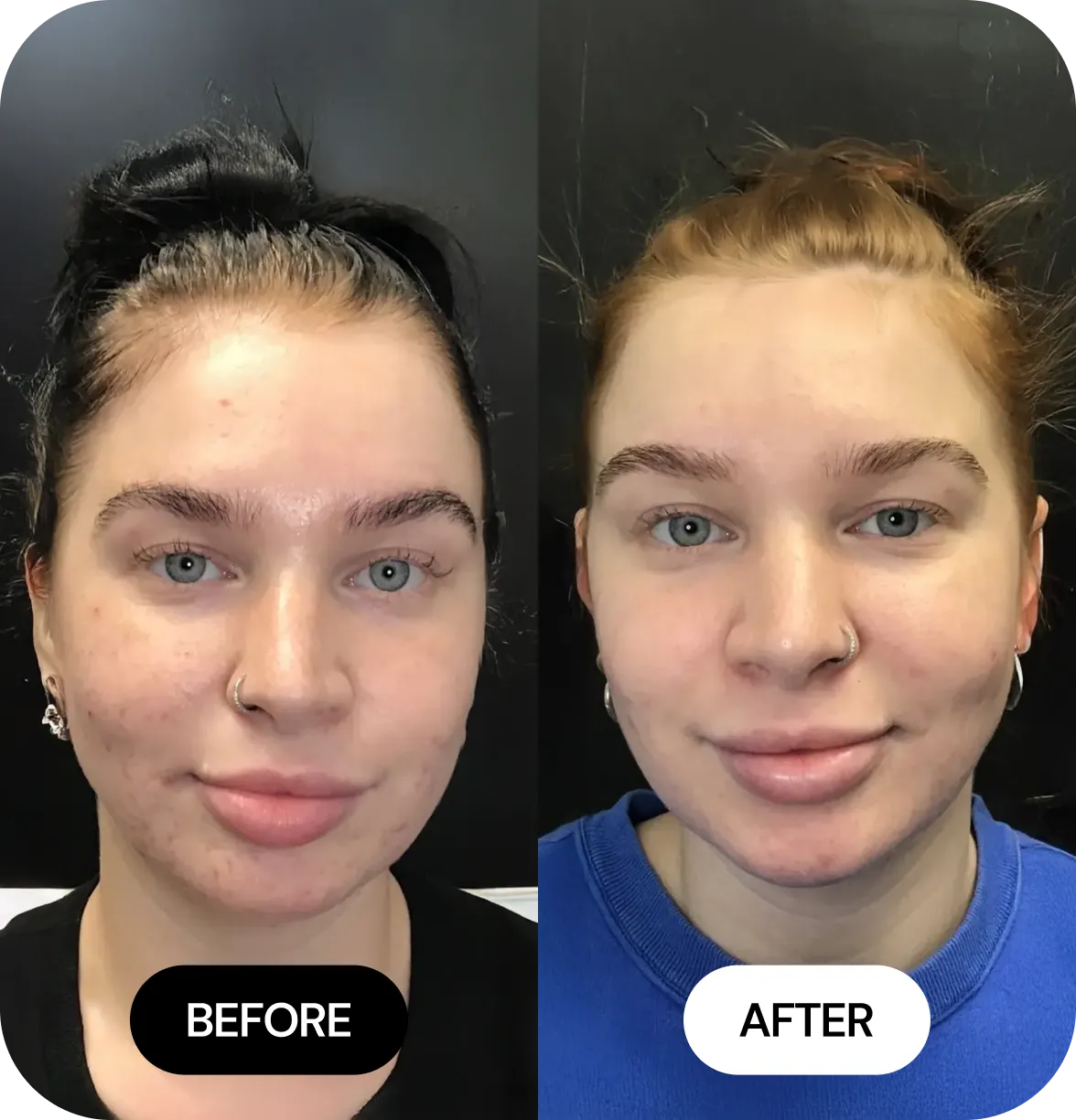 Microneedling before and after