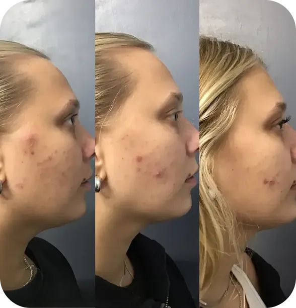 Microneedling before and after