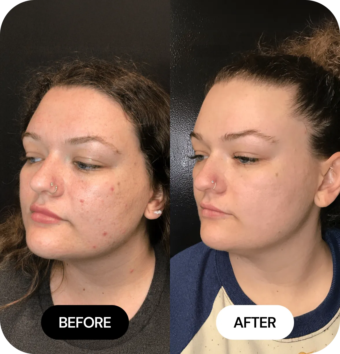 Microneedling before and after