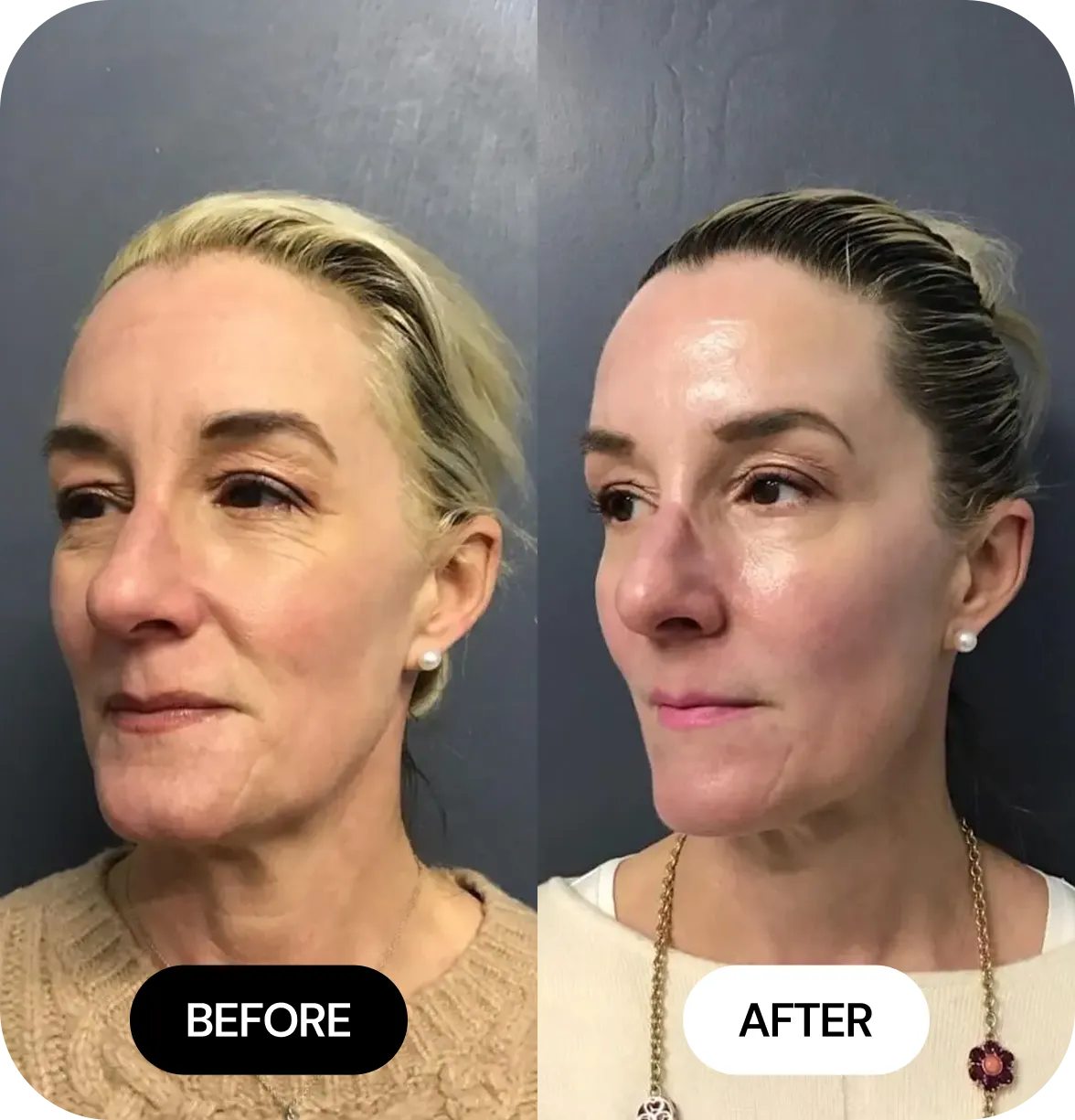 Microneedling before and after