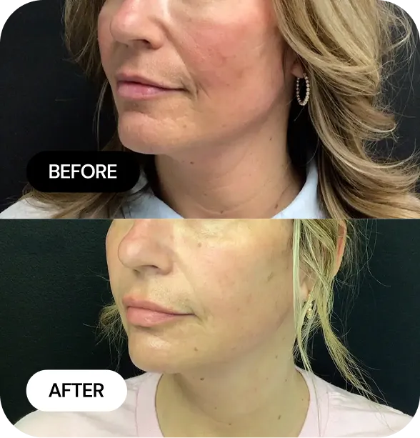 Microneedling before and after