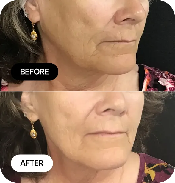 Microneedling before and after