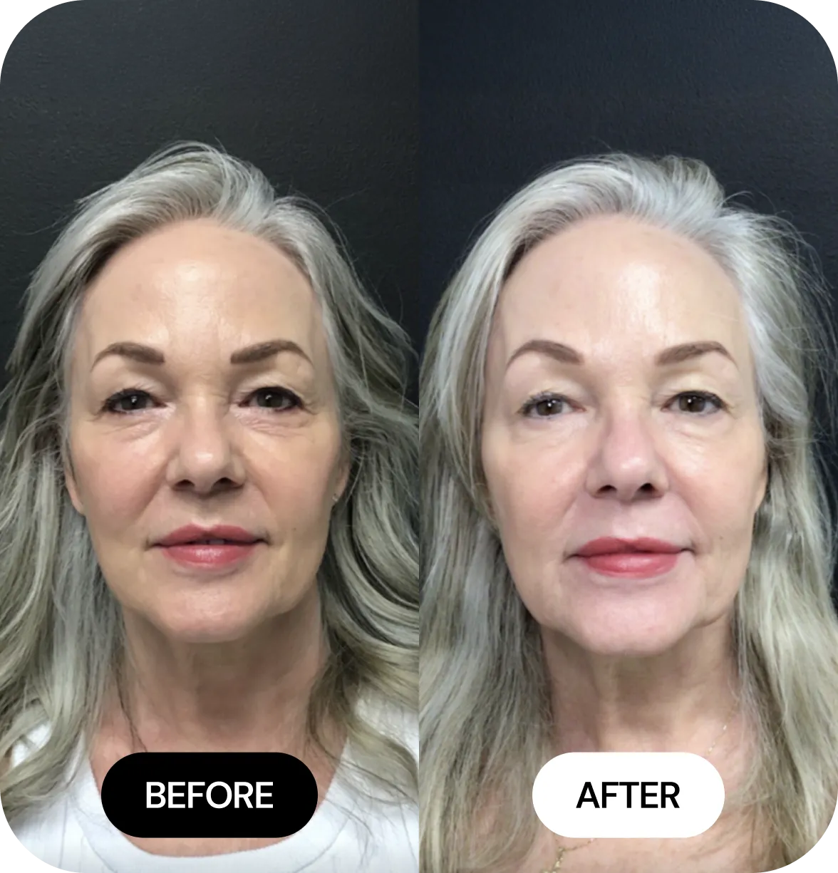 Microneedling before and after