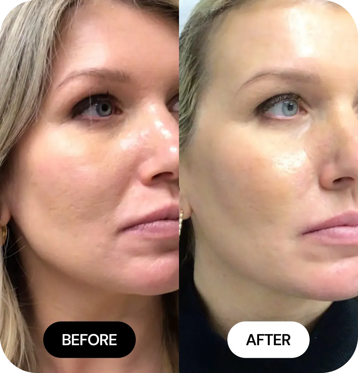 Microneedling before and after