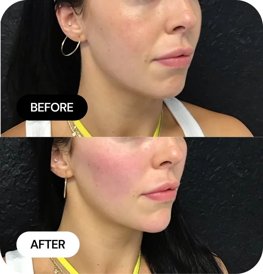 Mini-Jlyft before and after