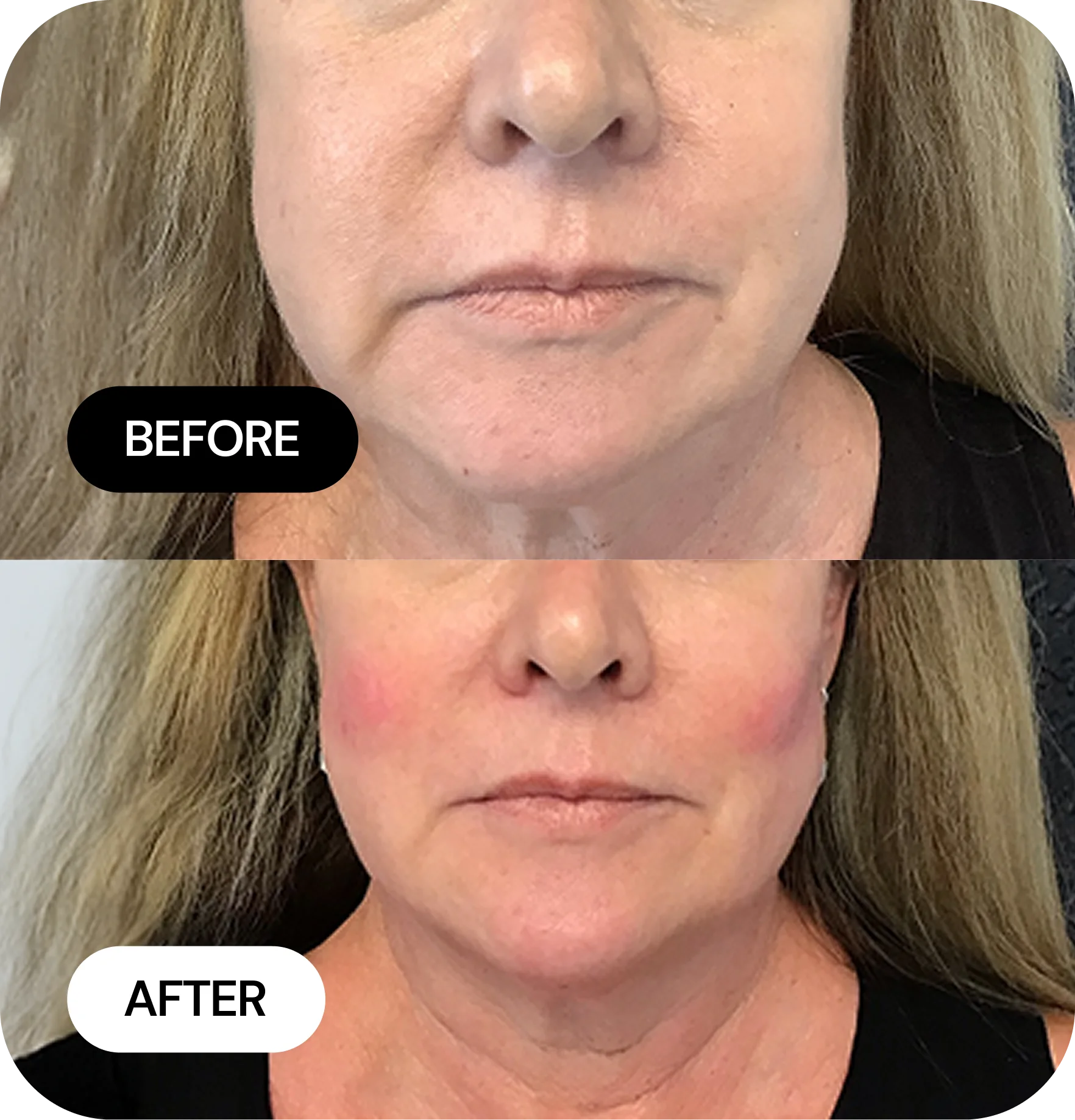 Mini-Jlyft before and after