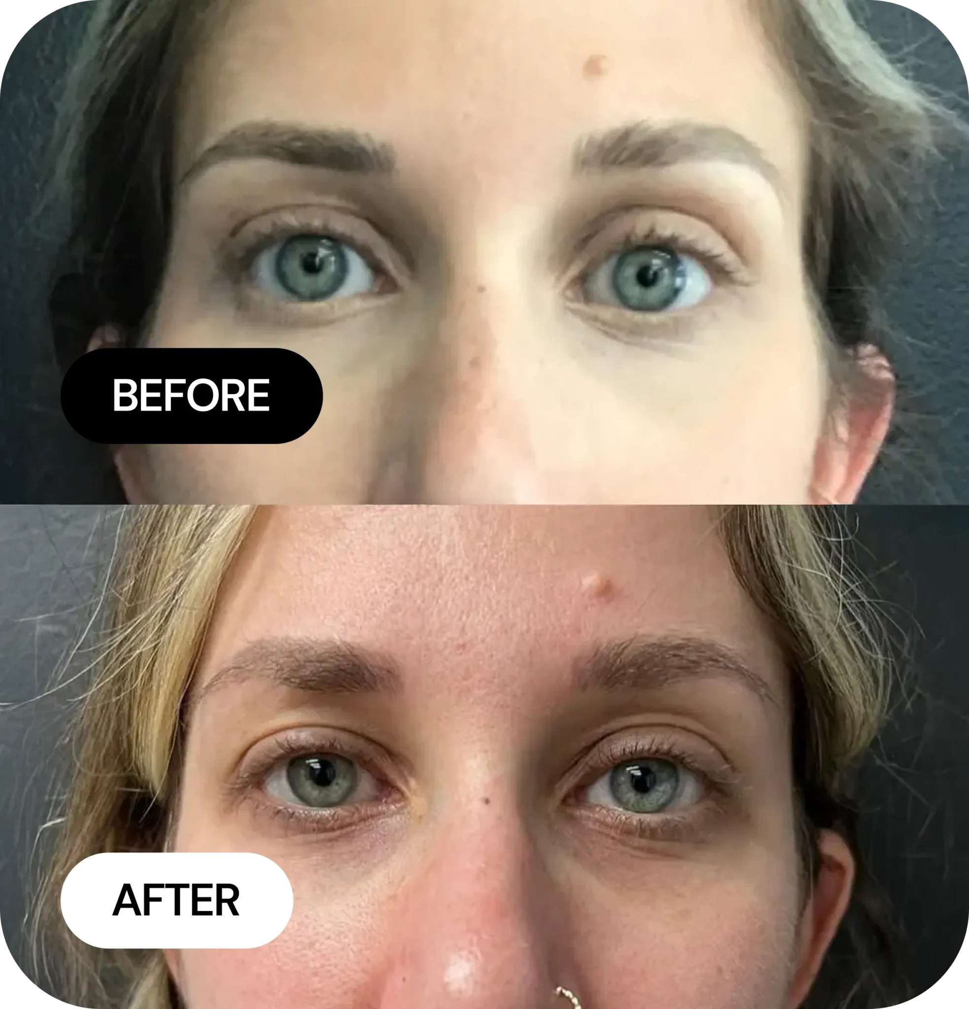 Mini-Jlyft before and after
