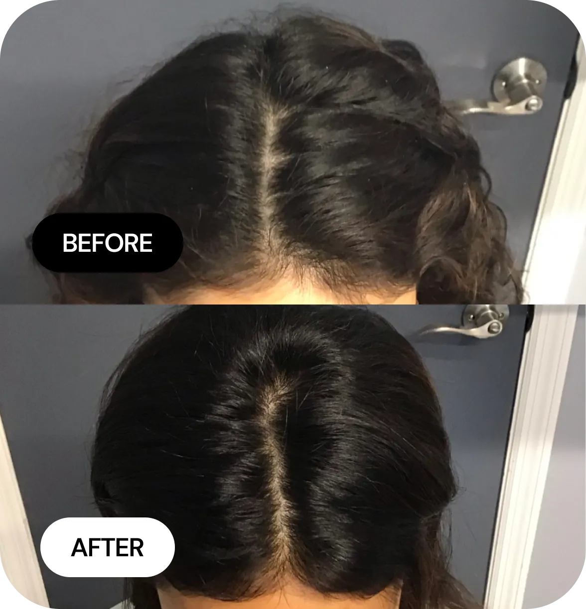 Hair Loss Treatments before and after