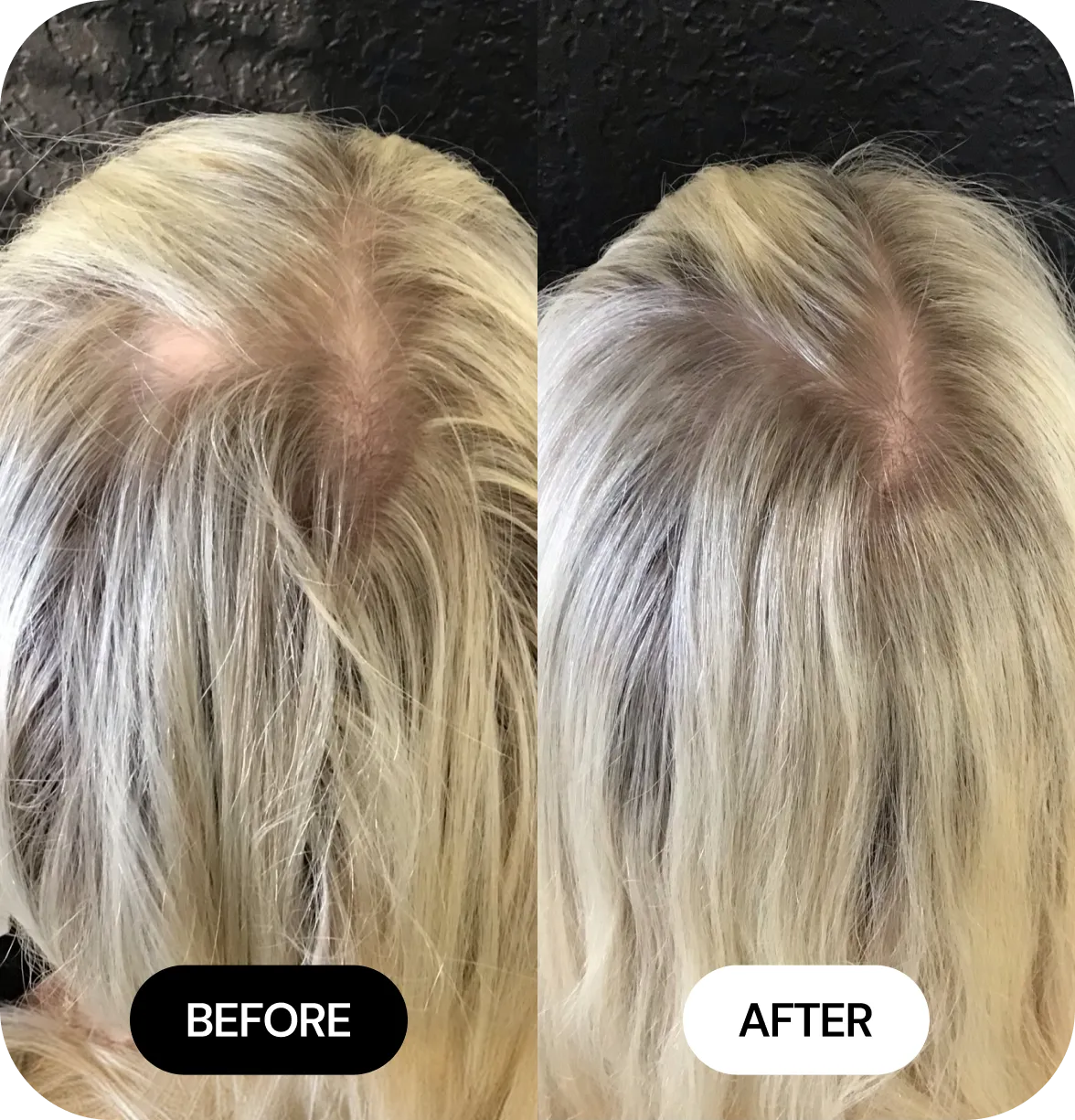 Hair Loss Treatments before and after