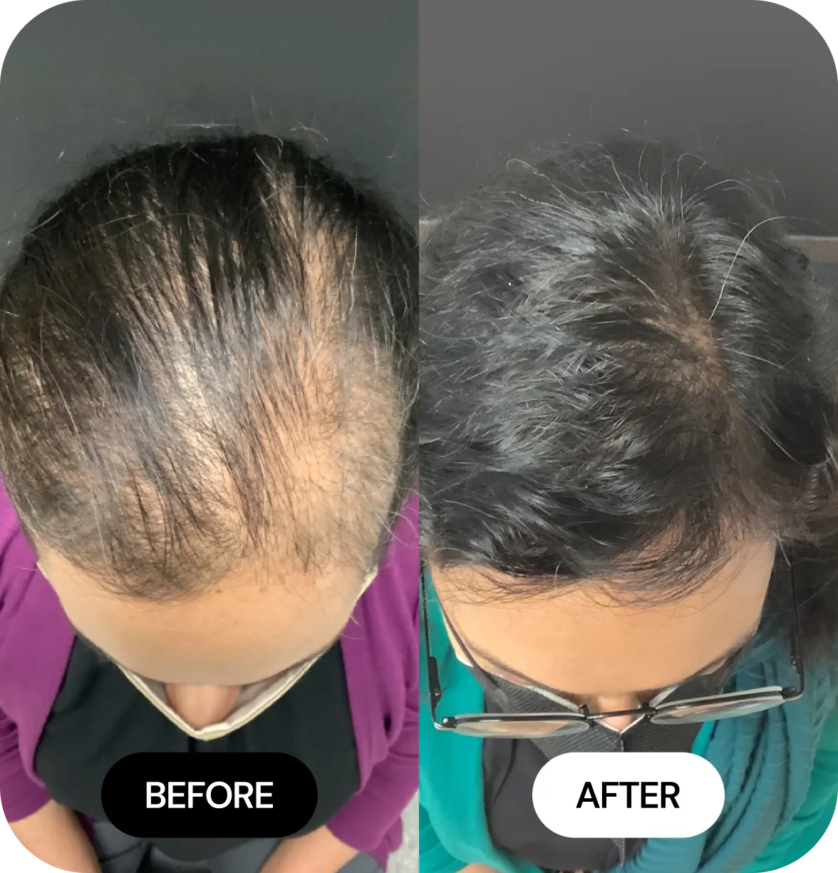 Hair Loss Treatments before and after