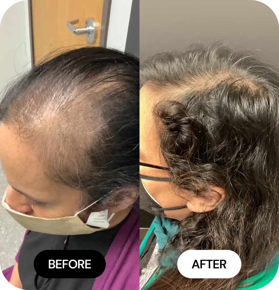 Hair Loss Treatments before and after
