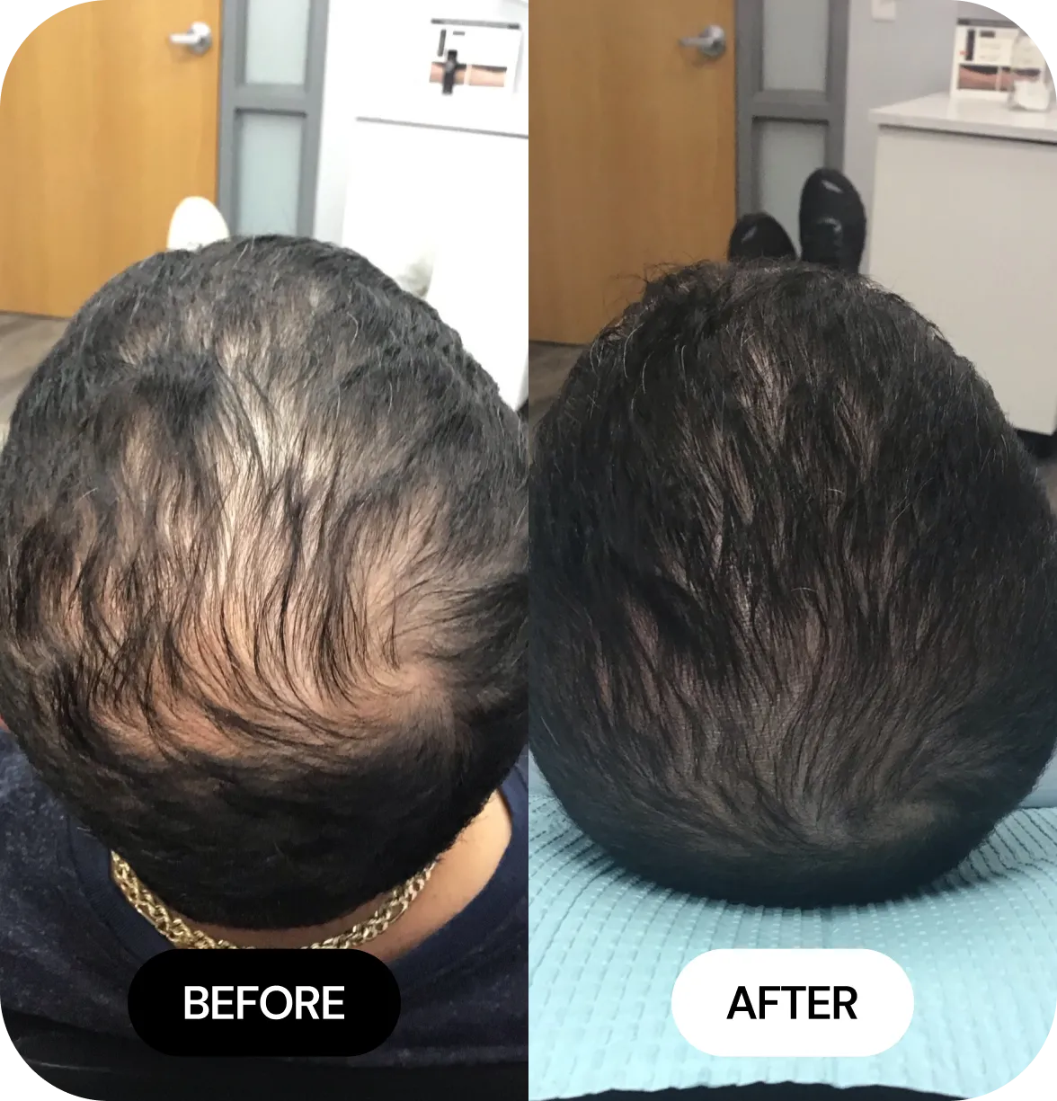 Hair Loss Treatments before and after