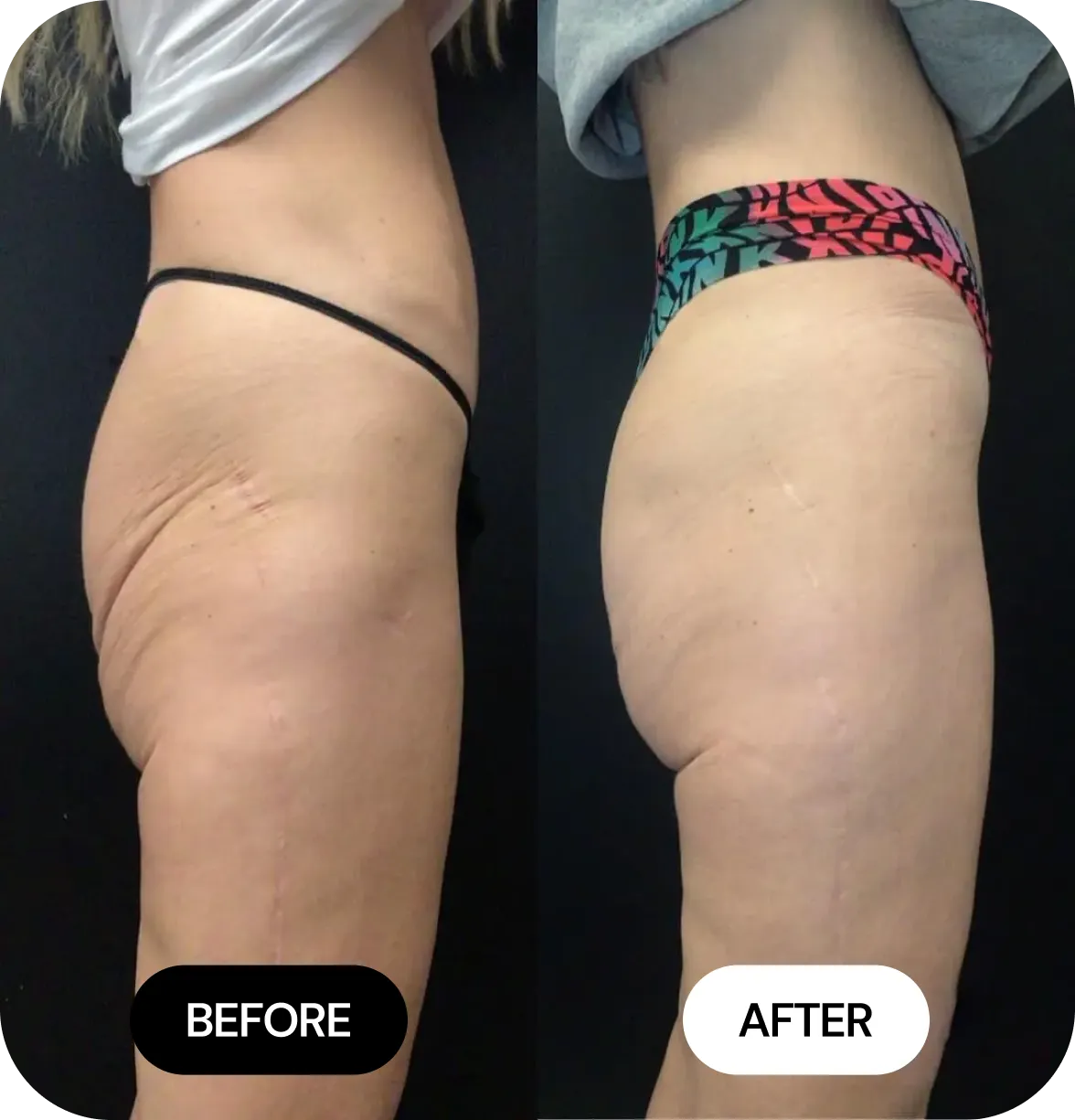 Non-Surgical BBL before and after