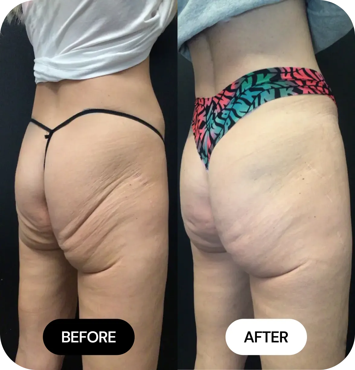 Non-Surgical BBL before and after