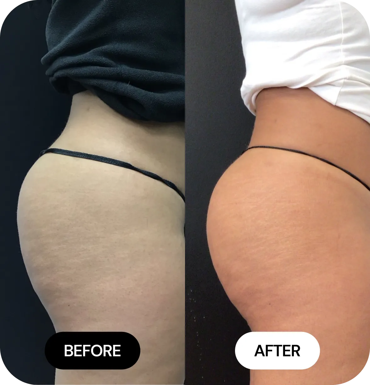 Non-Surgical BBL before and after