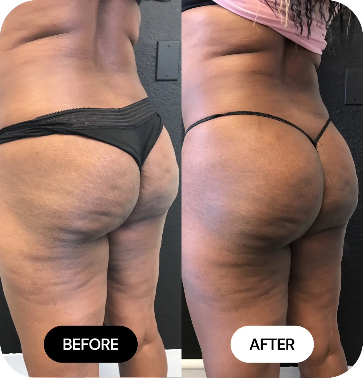 Non-Surgical BBL before and after