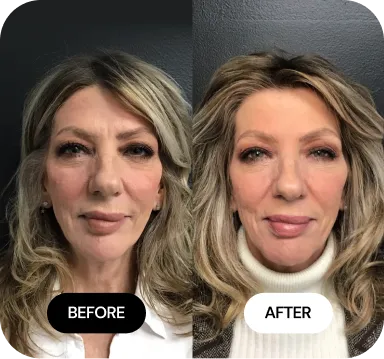Under-Eye Treatments before and after