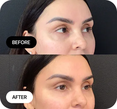 Under-Eye Treatments before and after