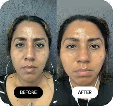 Under-Eye Treatments before and after