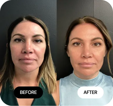 Under-Eye Treatments before and after