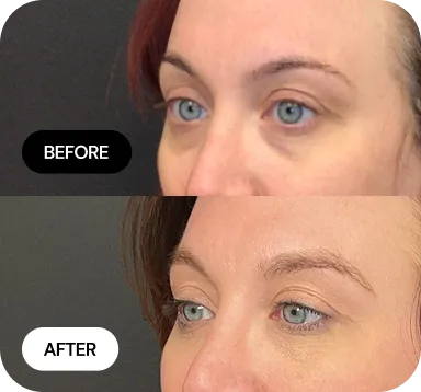 Under-Eye Treatments before and after