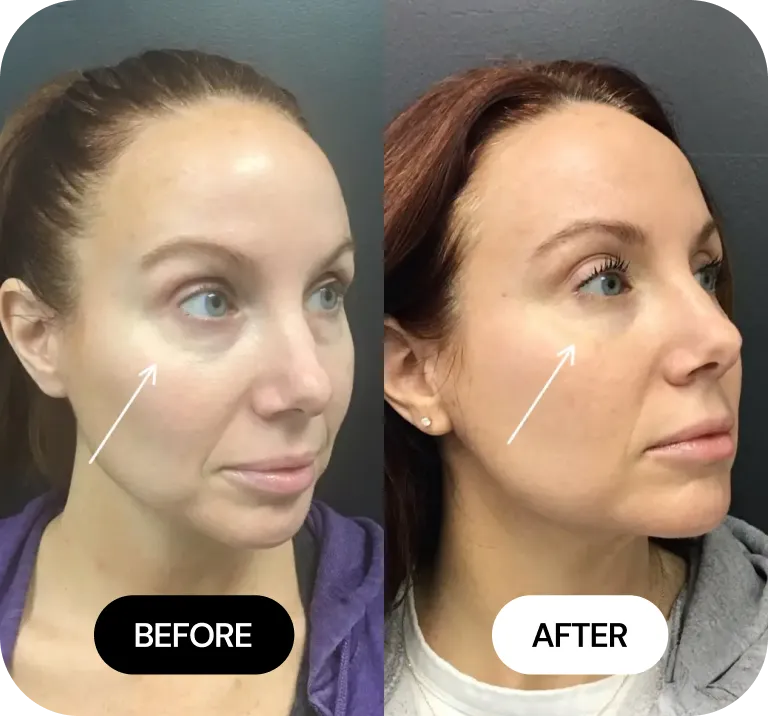 Under-Eye Treatments before and after