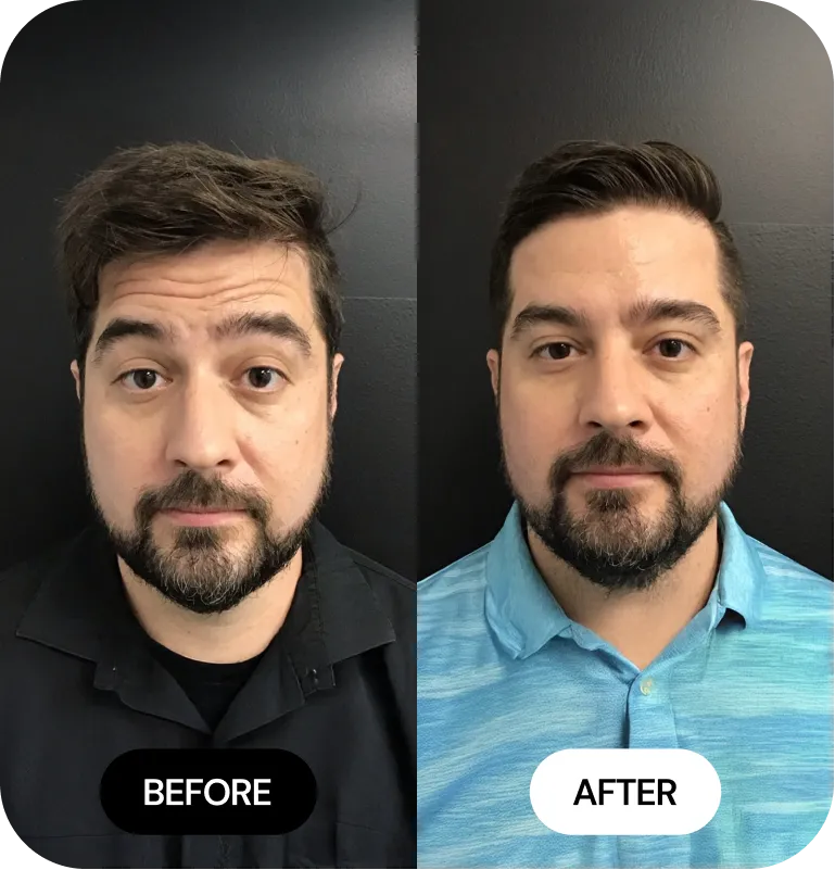 Wrinkle Relaxers before and after