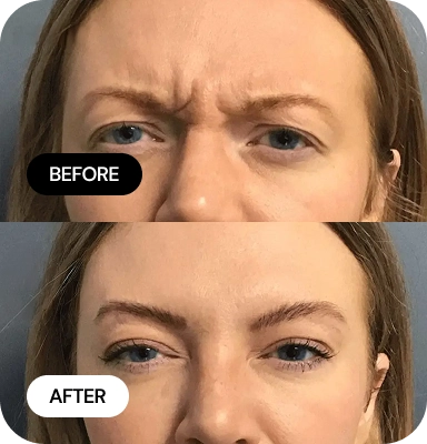 Wrinkle Relaxers before and after