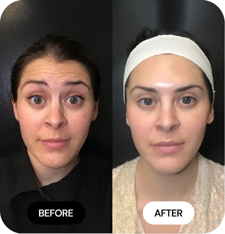 Wrinkle Relaxers before and after