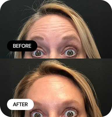 Wrinkle Relaxers before and after