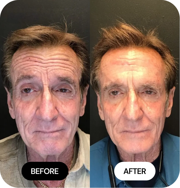 Wrinkle Relaxers before and after