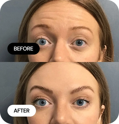 Wrinkle Relaxers before and after