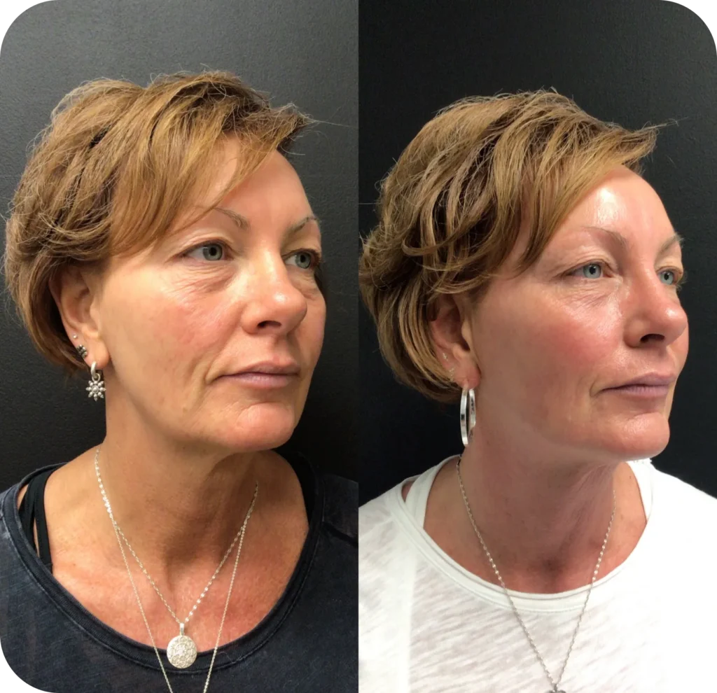 Microneedling During Treatment Image