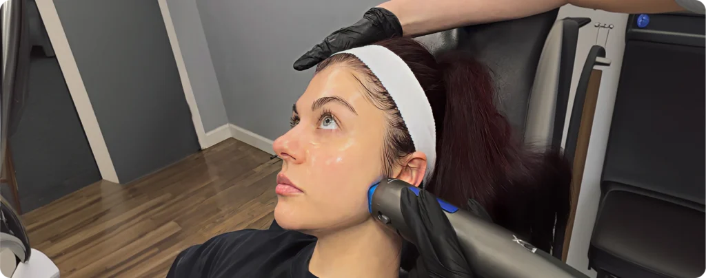 Microneedling Skin Resurfacing and Rejuvenation Treatments Fourth Img