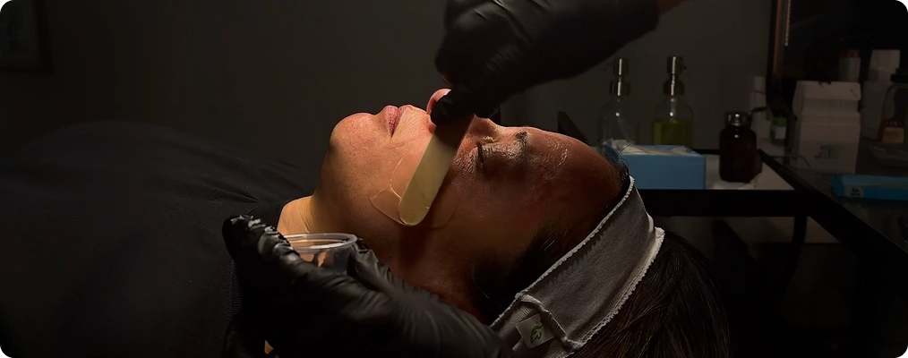Microneedling Skin Resurfacing and Rejuvenation Treatments Second Img